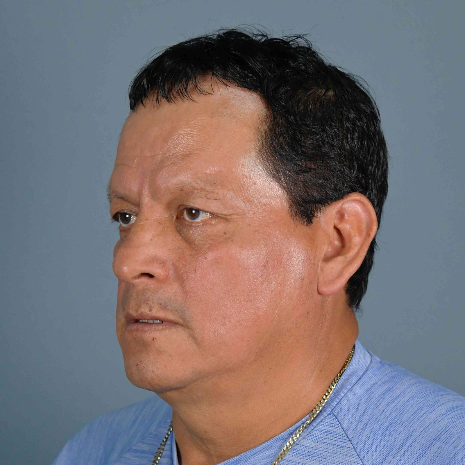 Caso real de blefaroplastia — paciente de Kento Cirugía y Nutrición