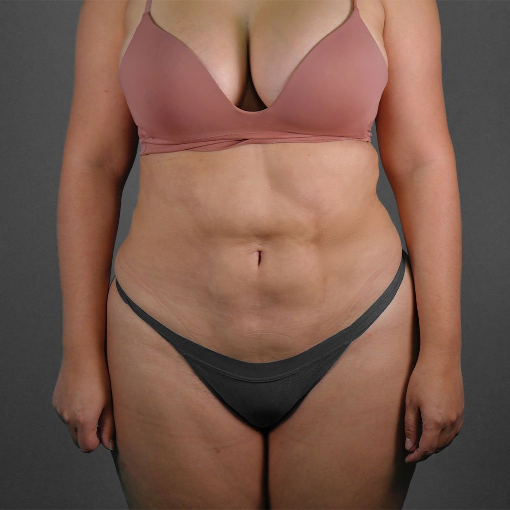 Resultado real de lipoescultura de abdomen — Kento Cirugía y Nutrición