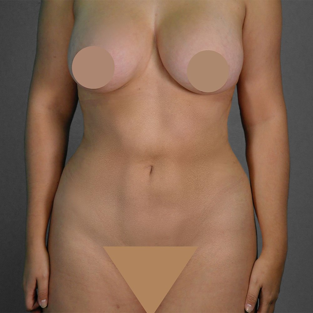 Resultado real de lipoescultura — Kento Cirugía y Nutrición en Quito